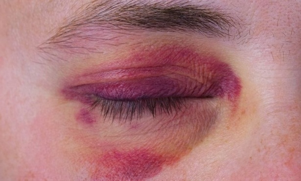 Мъж посини съпругата си от бой в Симитли