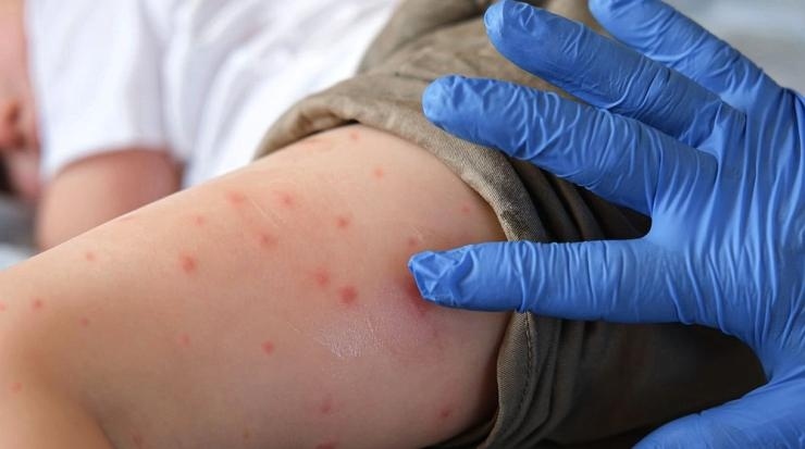 11 нови случая на морбили в България, общо заболелите са 61