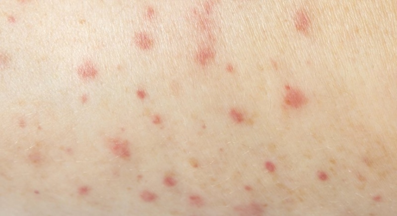 28 нови случая на морбили в област Враца за седмица