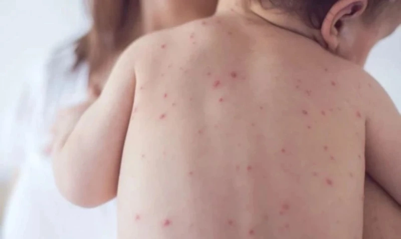 Морбили продължава да се разпространява – нови случаи в четири области у нас